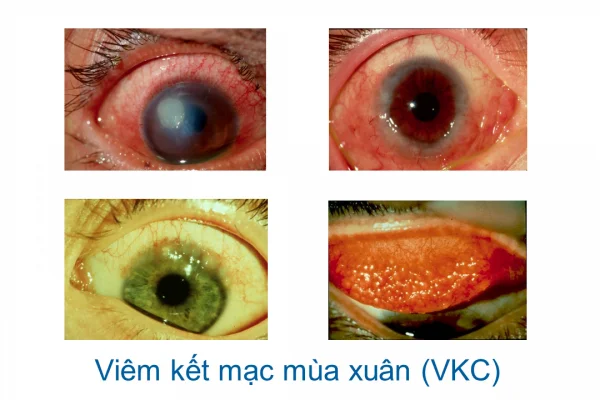 Viêm kết mạc mùa xuân, VKC