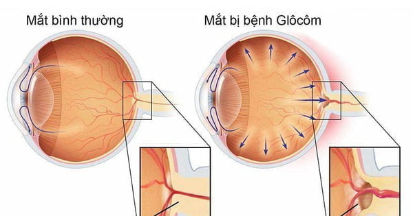 Triệu chứng Glocom