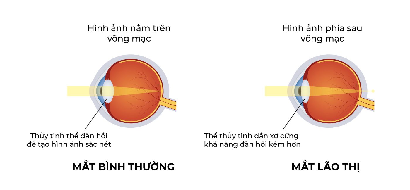 So sánh: Mắt bình thường vs Mắt lão thị